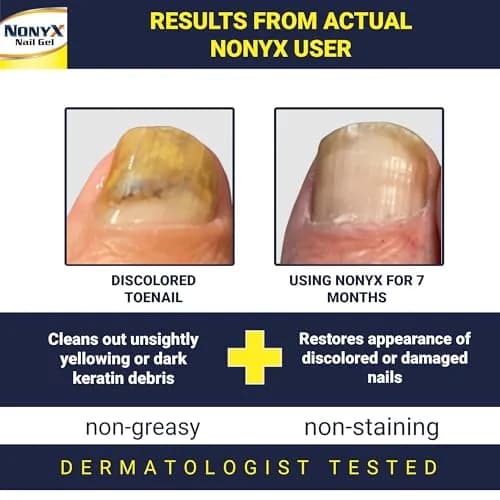 NONYX Fungal Nail Clarifying Gel 118ml (4 Fl Oz) | Clinically Proven to Improve Nail Appearance thumbnail 2