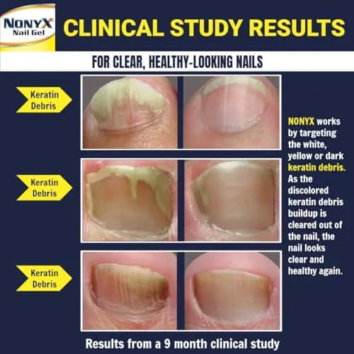NONYX Fungal Nail Clarifying Gel 118ml (4 Fl Oz) | Clinically Proven to Improve Nail Appearance thumbnail 3