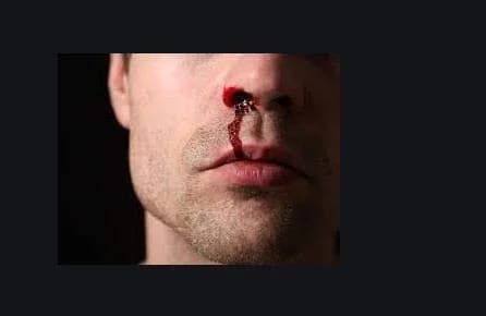 NasalCEASE FirstAid Nosebleeds | Natural Clotting Aid for All Ages in India thumbnail 3
