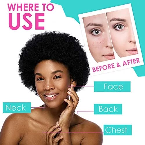 Bye Bye Blemish Acne Drying Lotion 1oz | Reduce Pimples Overnight for Sensitive Skin thumbnail 5
