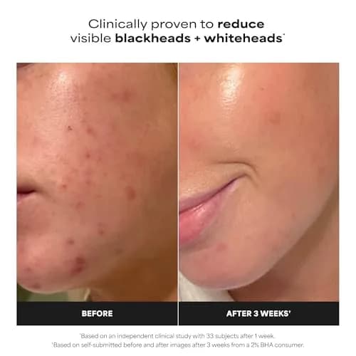 Paula's Choice SKIN PERFECTING 2% BHA Liquid Exfoliant 118ml (4 Fl Oz) | Gentle Chemical Exfoliator for Pores & Blackheads thumbnail 2
