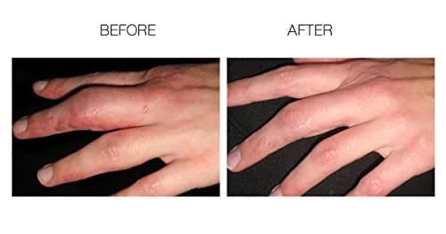 ScarFade Silicone Scar Gel for Scar Removal & Therapy - 30g | Clinically Tested, Non-Irritating, Unscented thumbnail 2