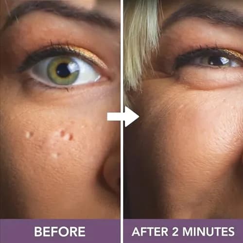 Dermaflage Scar Filler Kit - Deep - Waterproof Concealer for Acne & Wrinkles, 1 mo supply thumbnail 7