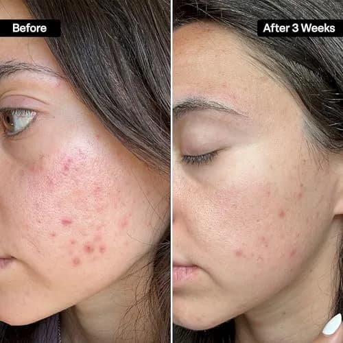 QRxLabs Salicylic & Glycolic Acid Acne Clearing Pads 50ct | Dual-Action Exfoliation for All Skin Types thumbnail 3