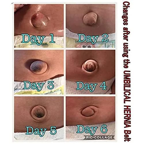 Paskyee Baby Umbilical Hernia Belt Blue | Adjustable Infant Belly Wrap for Newborns thumbnail 5