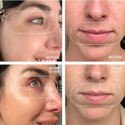 Dermaclara Eye & Mouth Patches | Reusable Silicone Anti-Wrinkle Pads for Smile Lines & Under Eye, 4 Count thumbnail 3