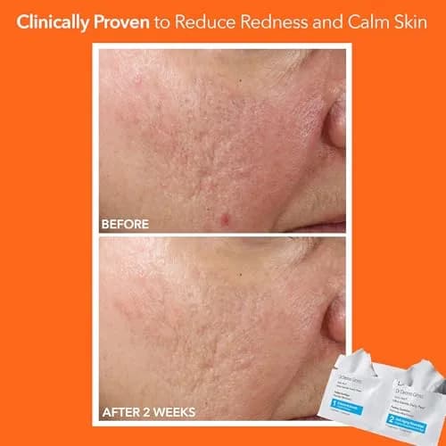 Dr Dennis Gross Alpha Beta Ultra Gentle Exfoliating Daily Peel - 5 Pack | Dermatologist-Formulated for Sensitive Skin thumbnail 4