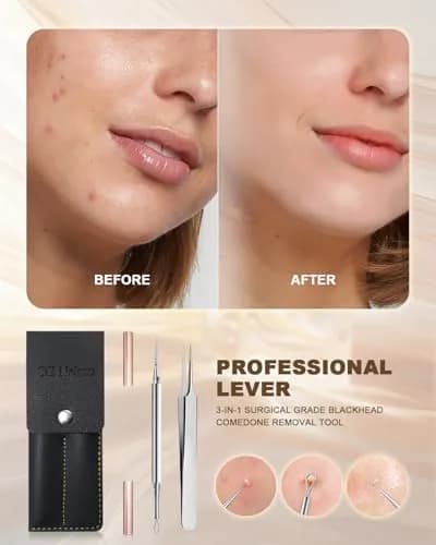 SG Nekoo Milia Remover Whitehead Extractor Tool Kit with Angled Loop & Acne Needle - Titanium Pink (3-Piece Set) thumbnail 3