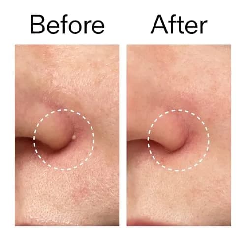 The INKEY List Hydrocolloid Invisible Pimple Patches 22 Pack | Fast-Acting, Seamless, All Skin Tones thumbnail 7