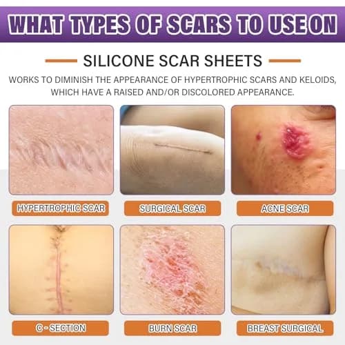 PSECICI Silicone Scar Sheets 3M (1.6" x 120") | Medical Grade Scar Tape for All Scar Types thumbnail 2