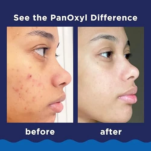 PanOxyl Acne Foaming Wash 10% Benzoyl Peroxide 85g (3 oz) | Kills Acne Bacteria on Contact thumbnail 4