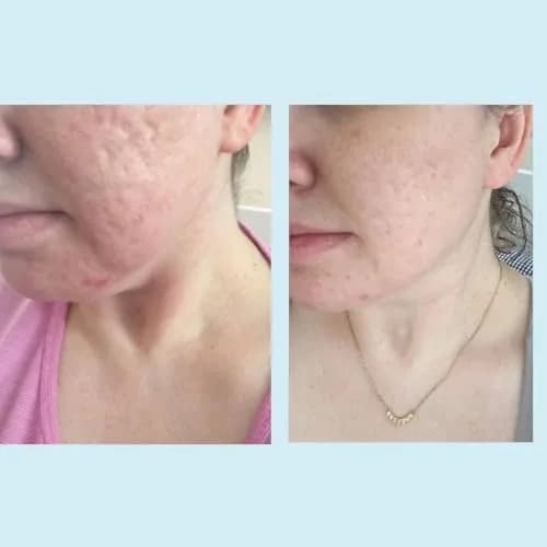 Perfect Image Glycolic Gel Peel 70% Strength for Experienced Users, 1 Fl Oz | High-Concentration Face Exfoliant thumbnail 6