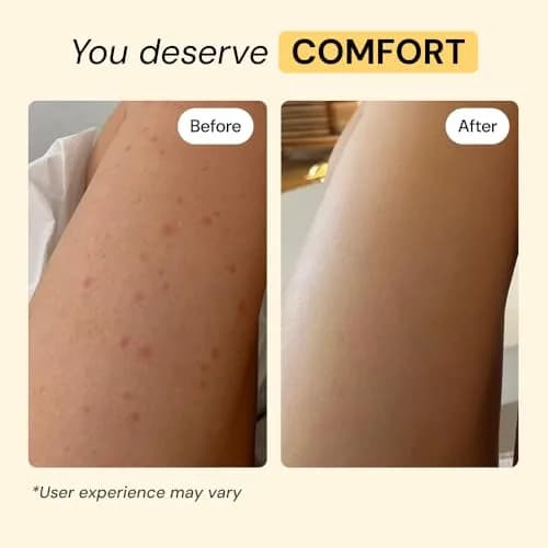 MyMagicHealer Thyme & Tea Tree Flare Care Salve 59ml (2 oz) | For Breakout-Prone Skin, Ingrown Hair, Razor Bumps thumbnail 4