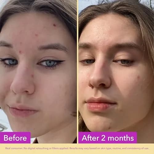 Good Molecules Niacinamide Serum Pack of 3 | 10% Niacinamide for Blemishes, Uneven Tone & Pores thumbnail 3