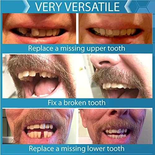Instant Smile Complete Your Smile Temporary Tooth Replacement Kit - Replace a Missing Tooth in Minutes - Patented (Pack of 2) thumbnail 5