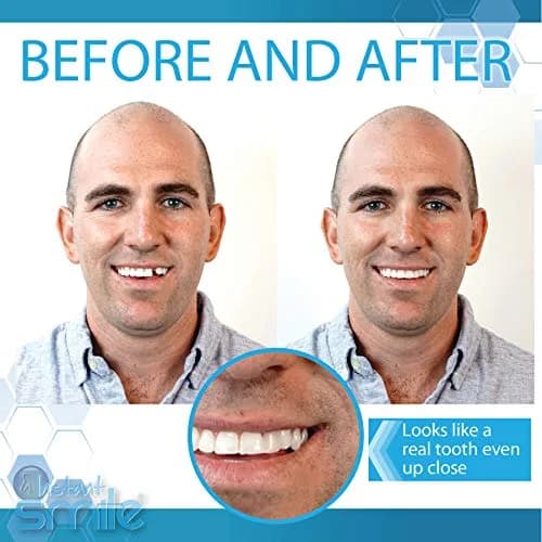Instant Smile Complete Your Smile Temporary Tooth Replacement Kit - Replace a Missing Tooth in Minutes - Patented (Pack of 2) thumbnail 3